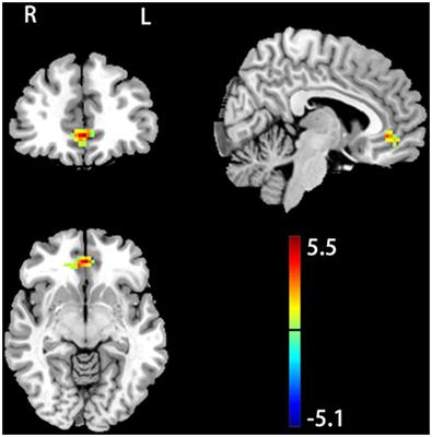 Increased Low-Frequency Resting-State Brain Activity by High-Frequency Repetitive TMS on the Left Dorsolateral Prefrontal Cortex